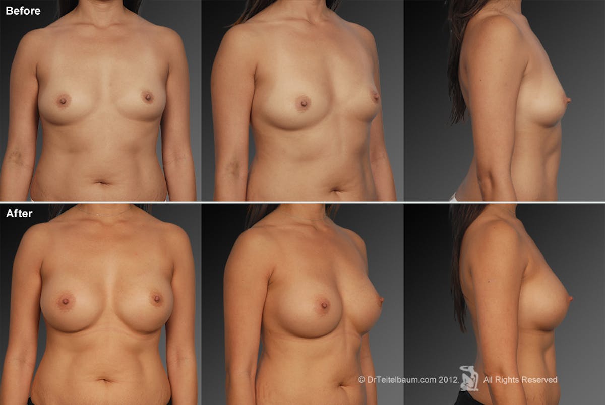 Breast Augmentation Before & After Gallery - Patient 104281821 - Image 1