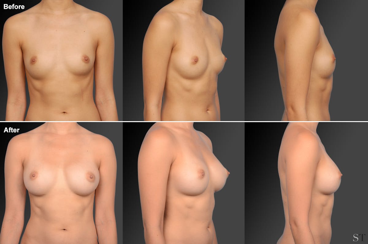 Breast Augmentation Before & After Gallery - Patient 104281838 - Image 1
