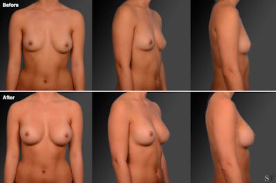 Breast Augmentation Before & After Gallery - Patient 104281842 - Image 1