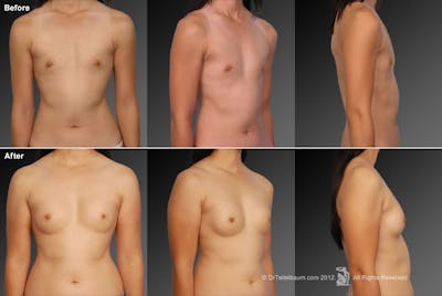 Breast Augmentation Before & After Gallery - Patient 104282993 - Image 1