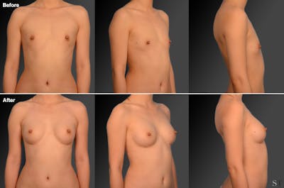 Breast Augmentation Before & After Gallery - Patient 104282995 - Image 1