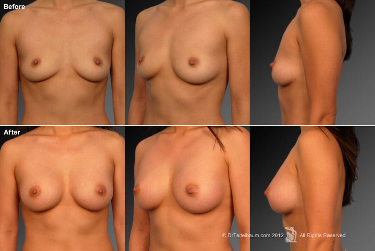 Breast Augmentation Before & After Gallery - Patient 104282998 - Image 1