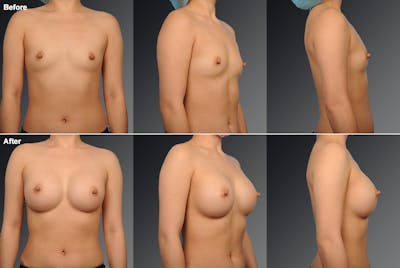 Breast Augmentation Before & After Gallery - Patient 104300940 - Image 1