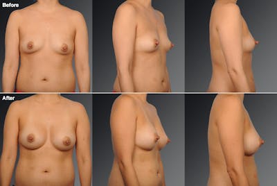 Breast Augmentation Before & After Gallery - Patient 104300967 - Image 1