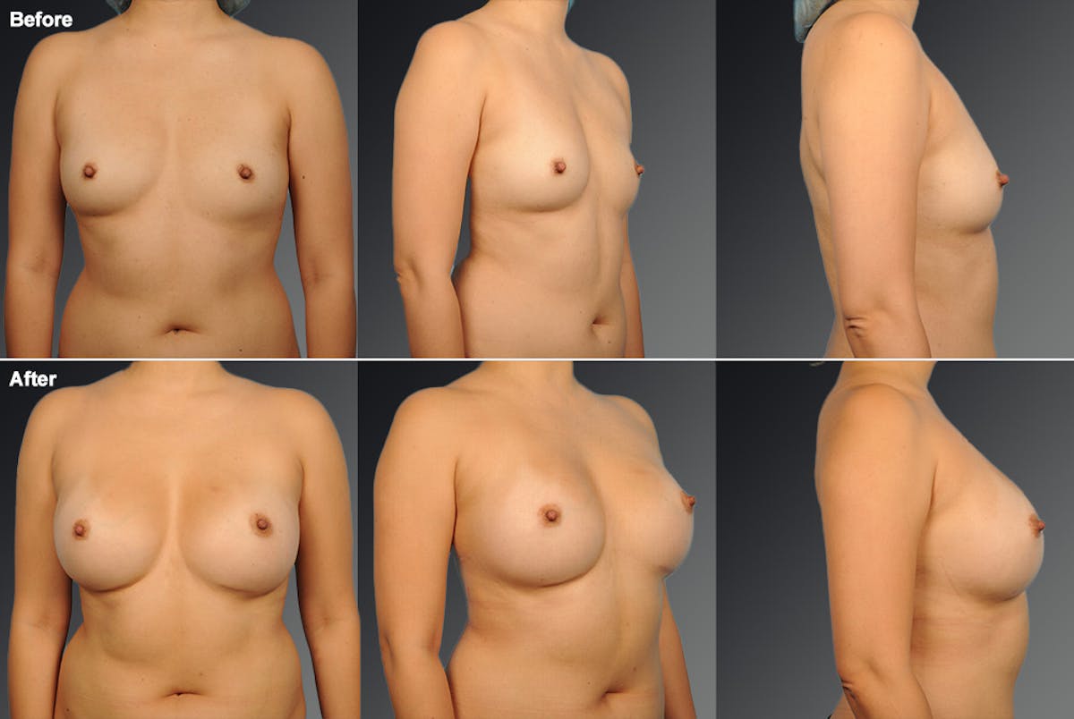Breast Augmentation Before & After Gallery - Patient 104301016 - Image 1