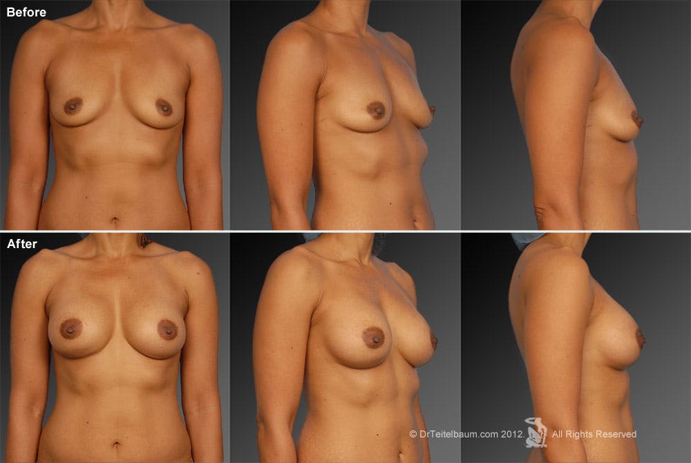 Breast Augmentation Before & After Gallery - Patient 104301029 - Image 1