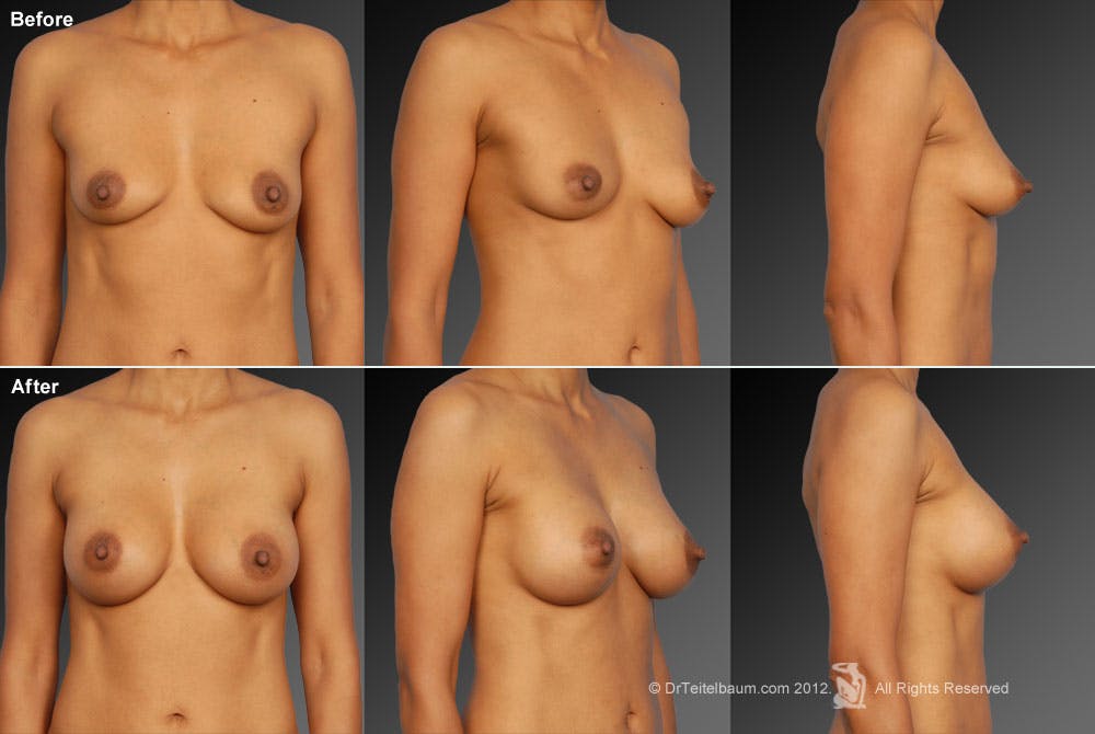Breast Augmentation Before & After Gallery - Patient 104301030 - Image 1