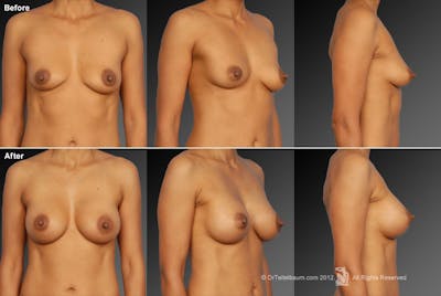Breast Augmentation Before & After Gallery - Patient 104301030 - Image 1