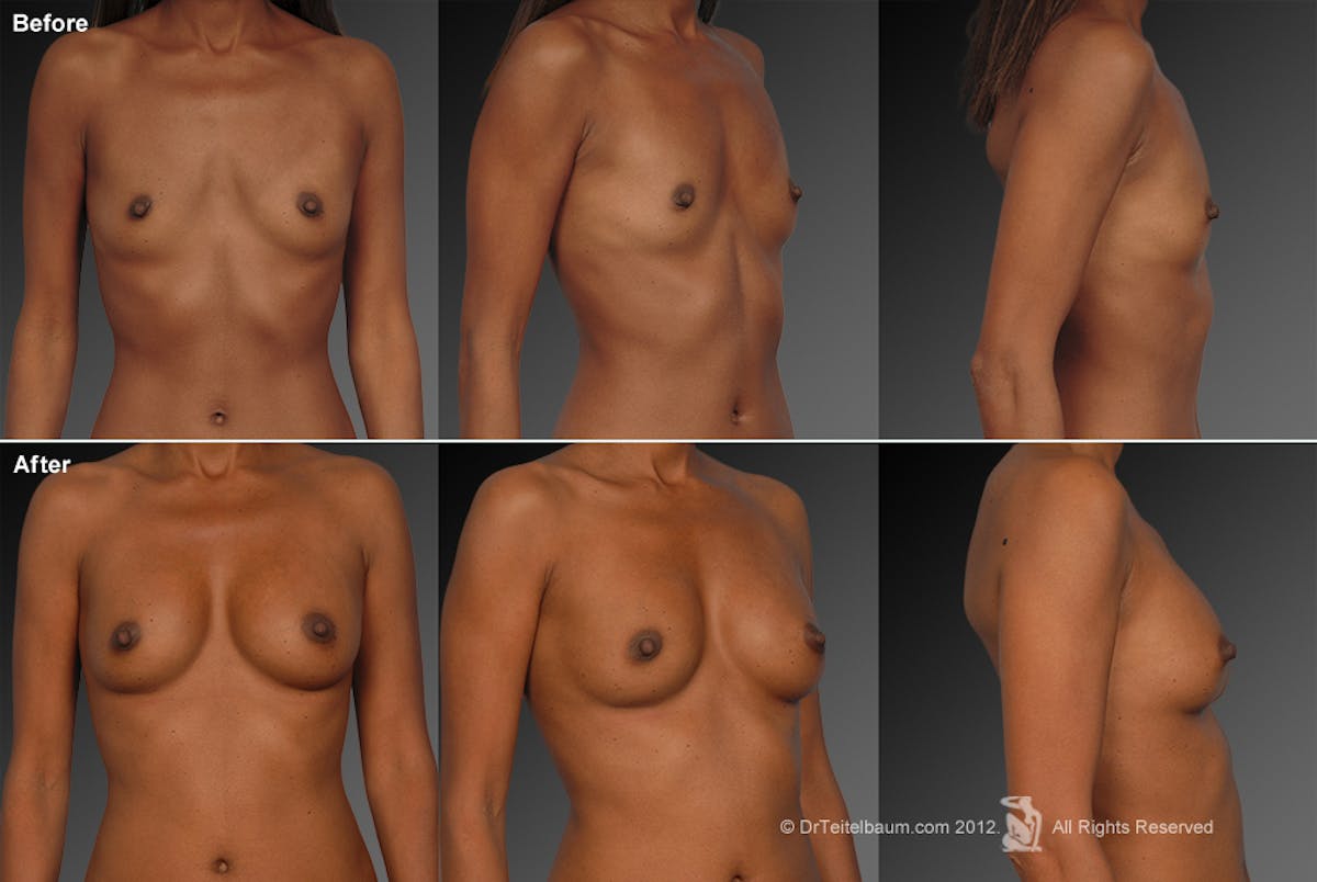 Breast Augmentation Before & After Gallery - Patient 104301033 - Image 1