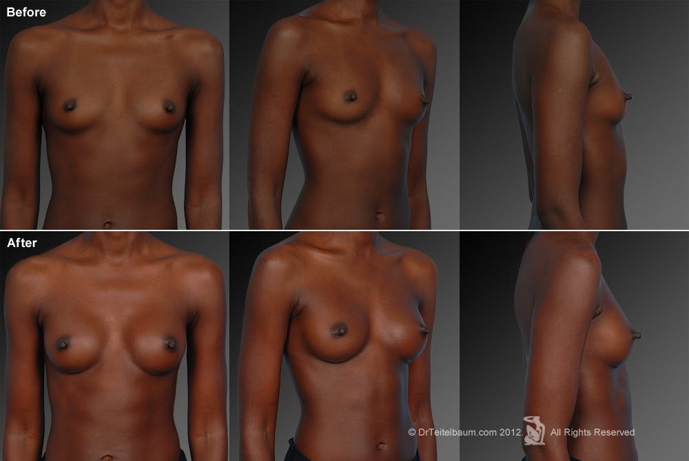 Breast Augmentation Before & After Gallery - Patient 104301034 - Image 1