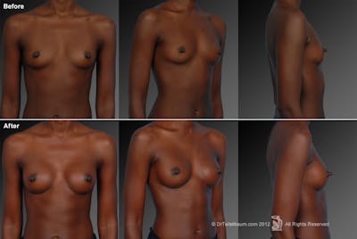 Breast Augmentation Before & After Gallery - Patient 104301034 - Image 1