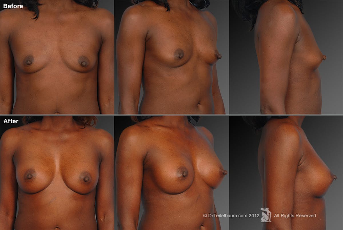 Breast Augmentation Before & After Gallery - Patient 104301035 - Image 1