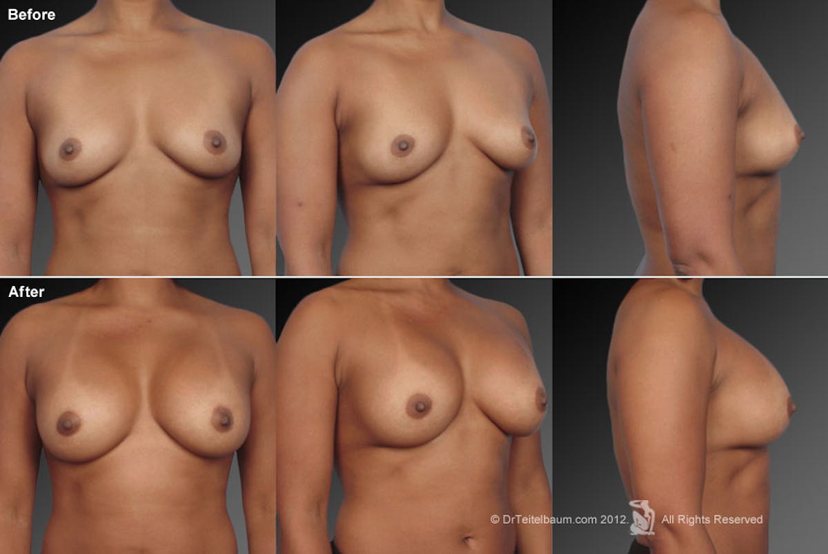 Breast Augmentation Before & After Gallery - Patient 104301051 - Image 1
