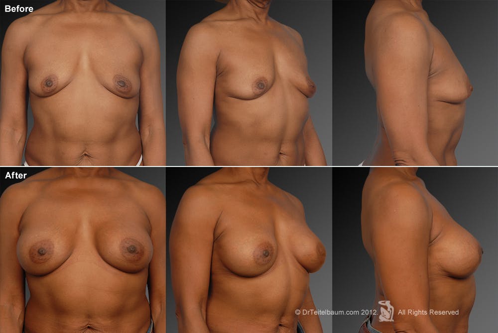 Breast Augmentation Before & After Gallery - Patient 104301053 - Image 1