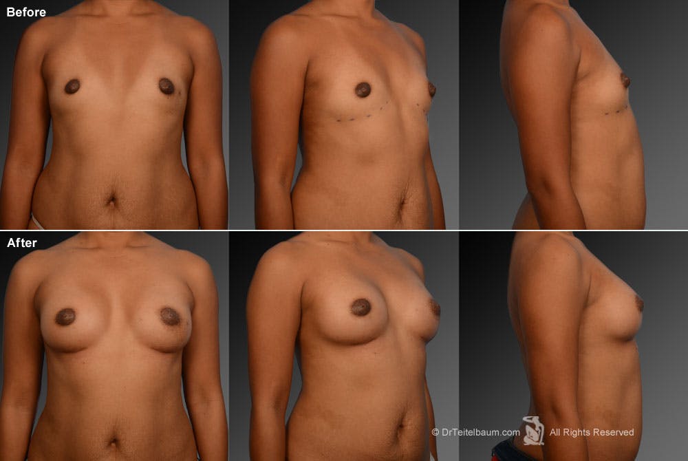 Breast Augmentation Before & After Gallery - Patient 104301057 - Image 1
