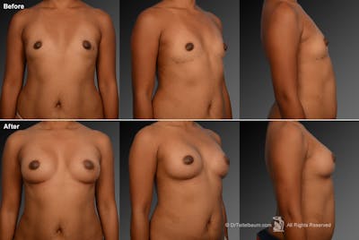 Breast Augmentation Before & After Gallery - Patient 104301057 - Image 1