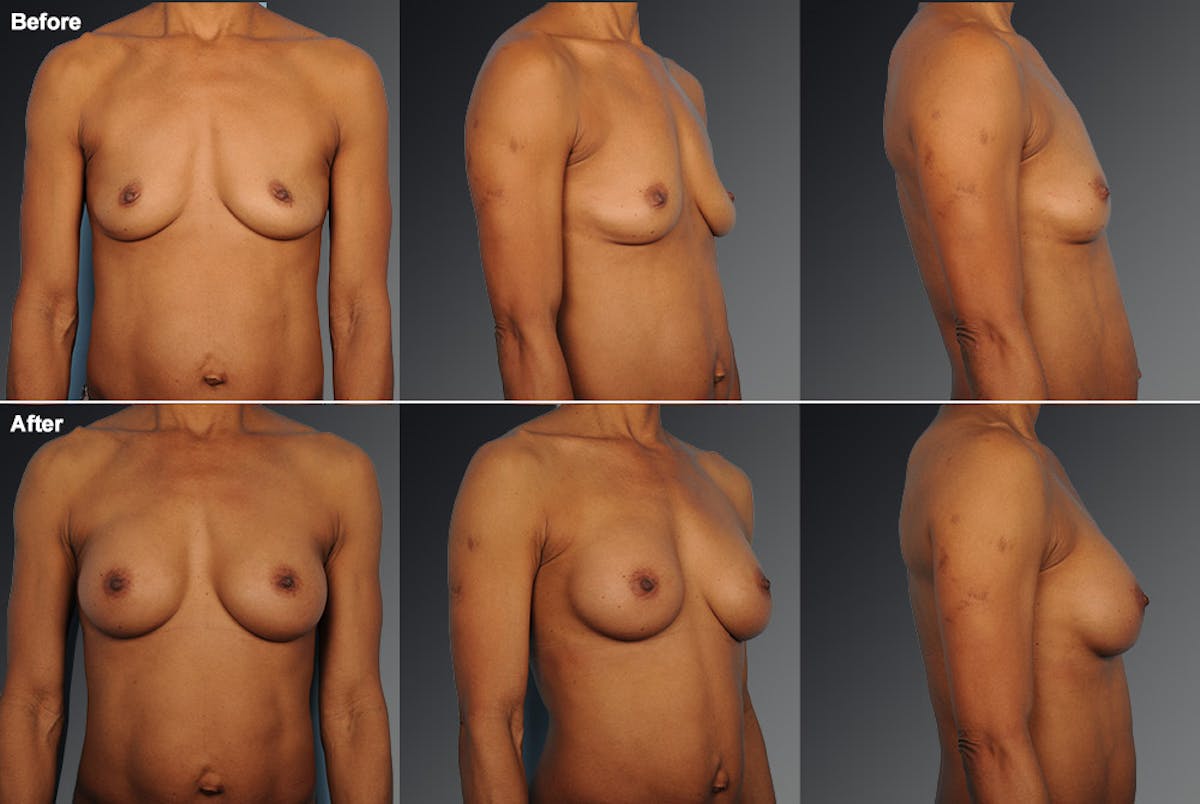 Breast Augmentation Before & After Gallery - Patient 104301075 - Image 1