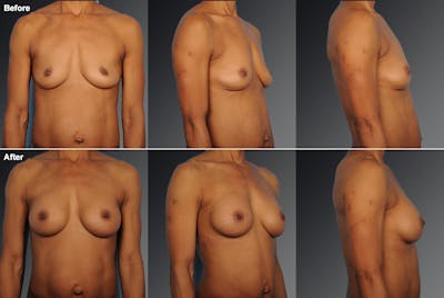 Breast Augmentation Before & After Gallery - Patient 104301075 - Image 1