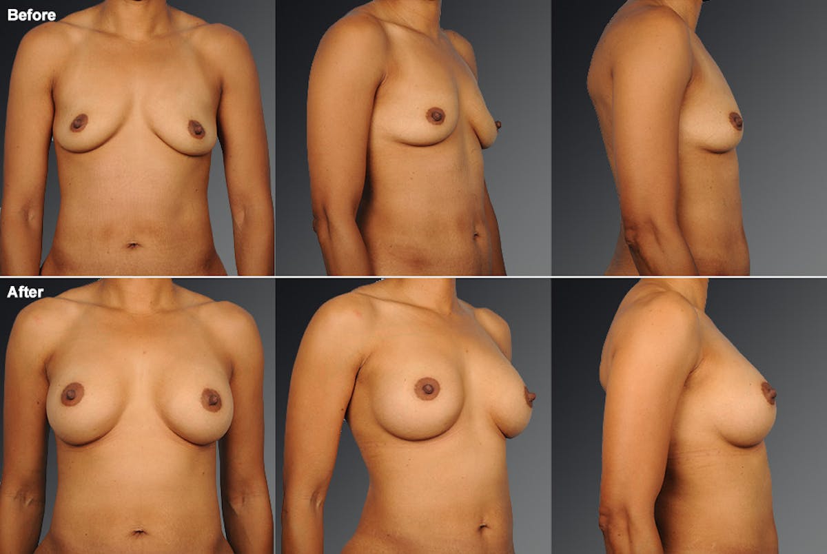 Breast Augmentation Before & After Gallery - Patient 104301076 - Image 1