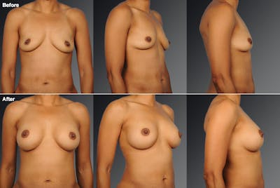 Breast Augmentation Before & After Gallery - Patient 104301079 - Image 1