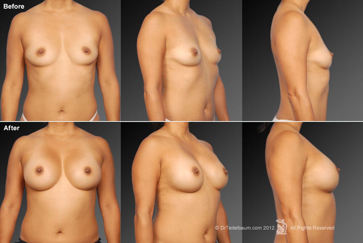 Breast Augmentation Before & After Gallery - Patient 104301107 - Image 1