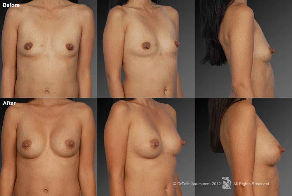 Breast Augmentation Before & After Gallery - Patient 104301136 - Image 1