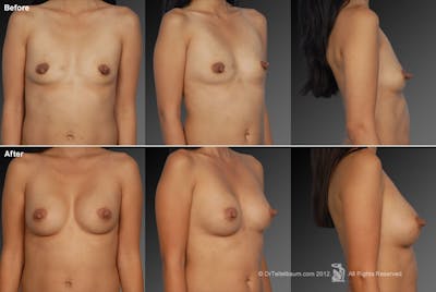 Breast Augmentation Before & After Gallery - Patient 104301136 - Image 1