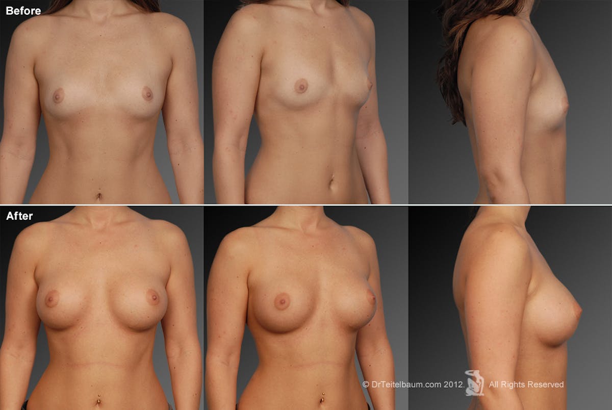 Breast Augmentation Before & After Gallery - Patient 104301140 - Image 1