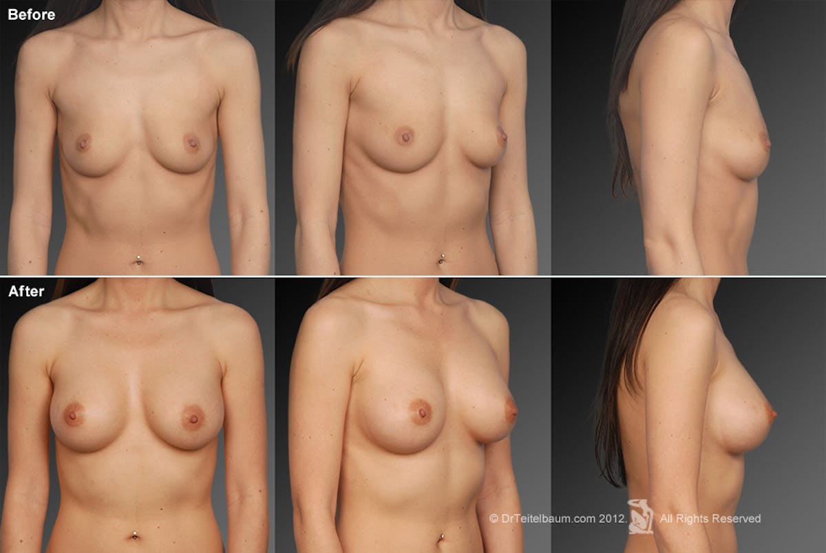 Breast Augmentation Before & After Gallery - Patient 104301143 - Image 1