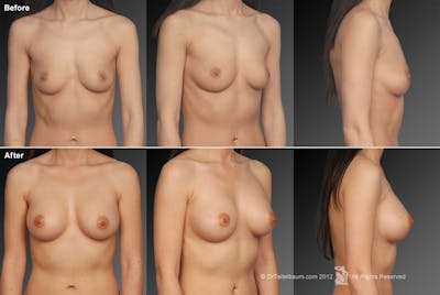 Breast Augmentation Before & After Gallery - Patient 104301143 - Image 1