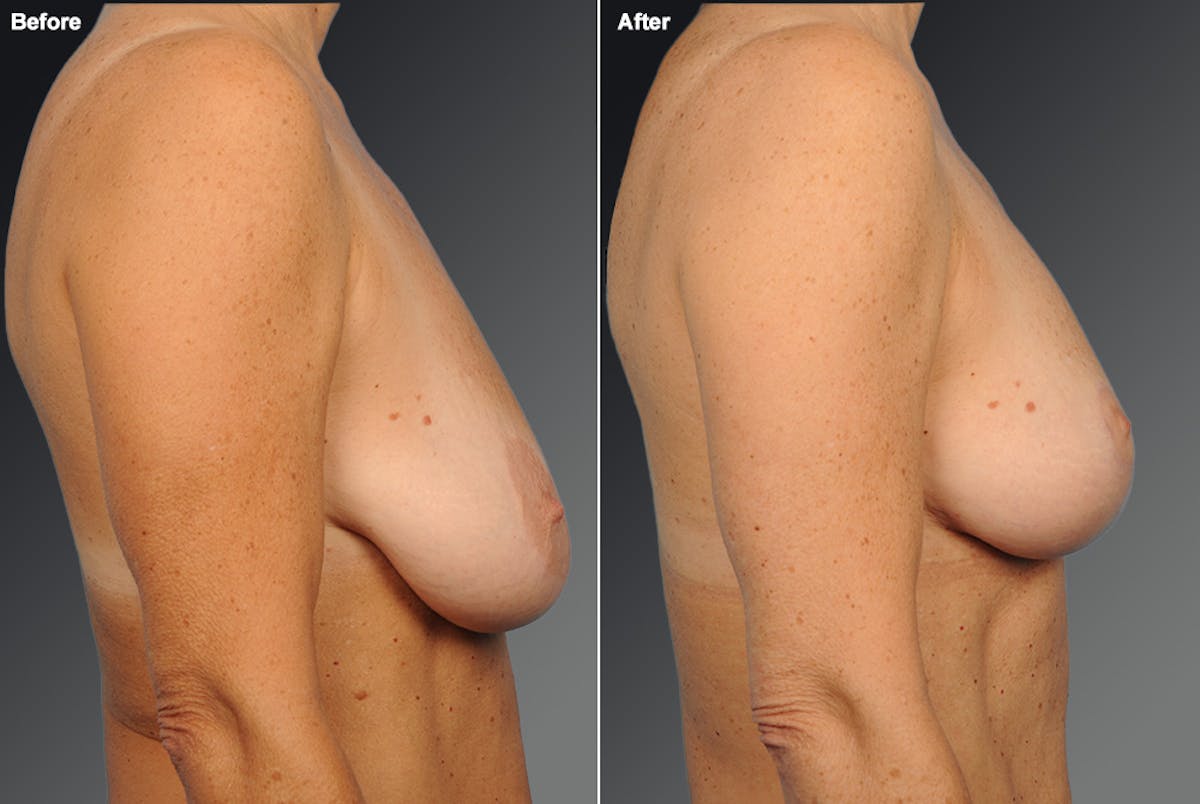 Breast Augmentation Before & After Gallery - Patient 104301185 - Image 1