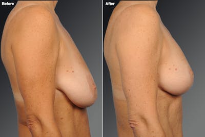 Breast Augmentation Before & After Gallery - Patient 104301185 - Image 1