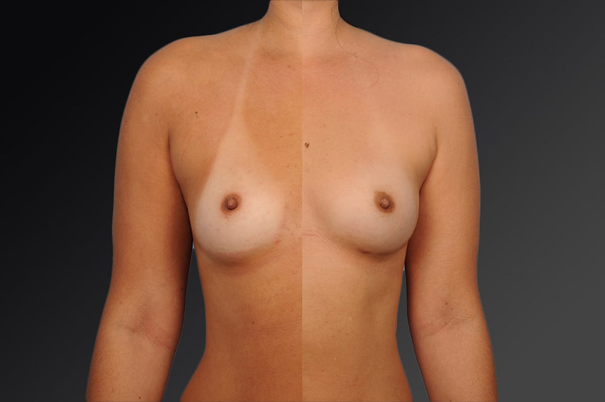 Breast Augmentation Before & After Gallery - Patient 104301193 - Image 1