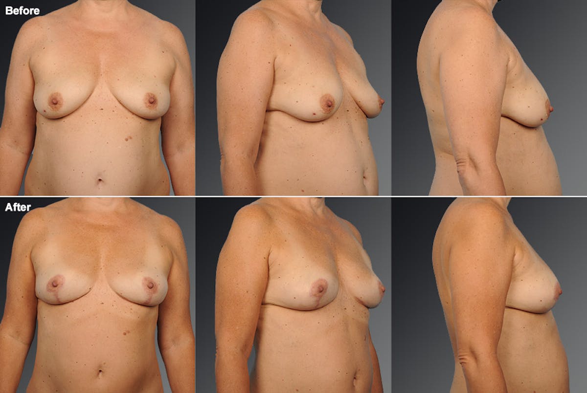 Breast Augmentation Before & After Gallery - Patient 104301198 - Image 1