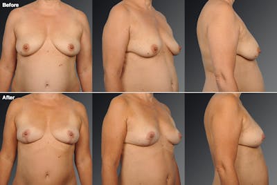 Breast Augmentation Before & After Gallery - Patient 104301198 - Image 1