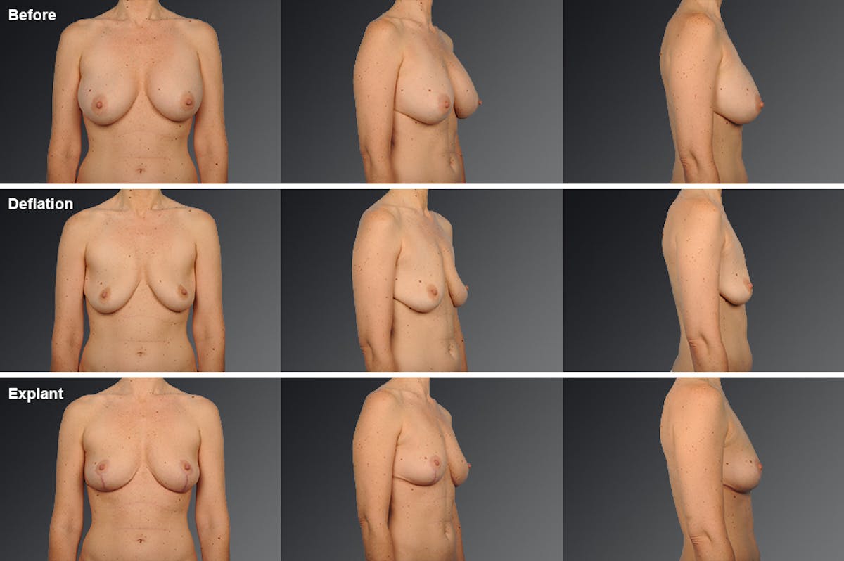 Breast Augmentation Before & After Gallery - Patient 104301202 - Image 1