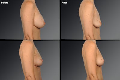 Breast Augmentation Before & After Gallery - Patient 104301210 - Image 1