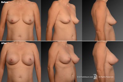 Breast Augmentation Before & After Gallery - Patient 104301275 - Image 1