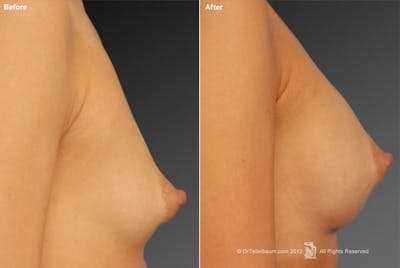 Breast Augmentation Before & After Gallery - Patient 104301291 - Image 1
