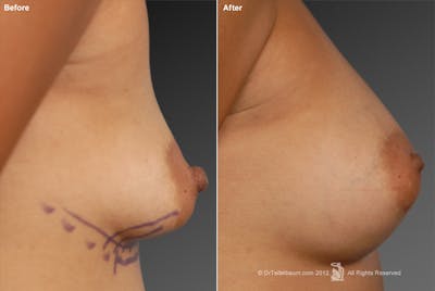 Breast Augmentation Before & After Gallery - Patient 104301307 - Image 1