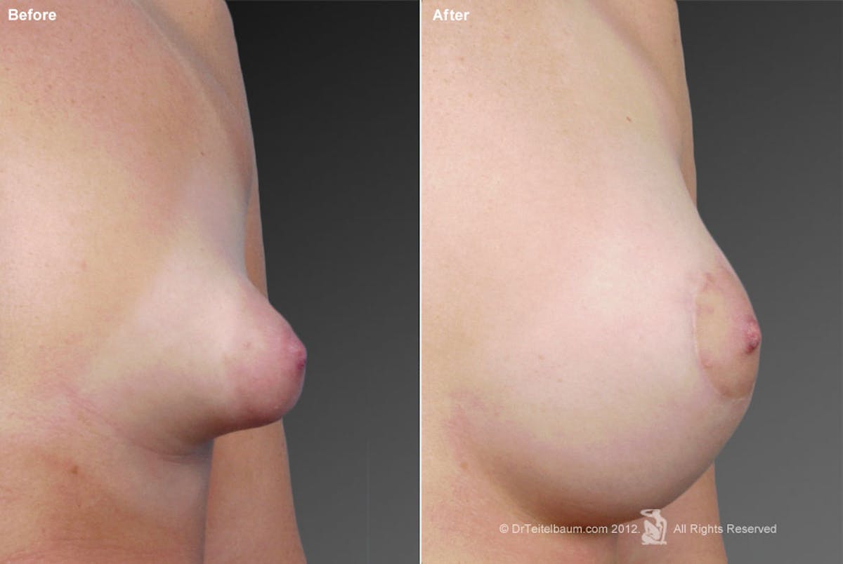 Breast Augmentation Before & After Gallery - Patient 104301310 - Image 1