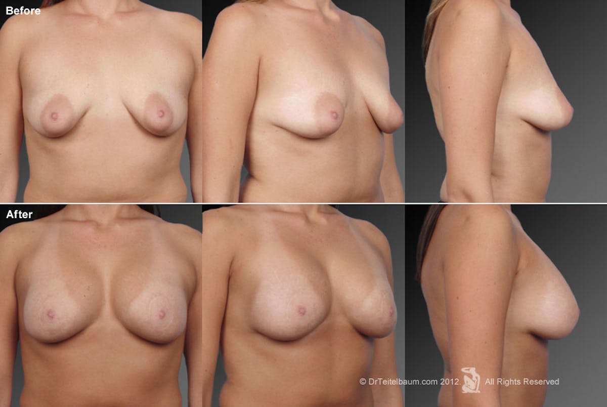 Breast Augmentation Before & After Gallery - Patient 104301312 - Image 1