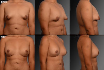 Breast Augmentation Before & After Gallery - Patient 104301327 - Image 1