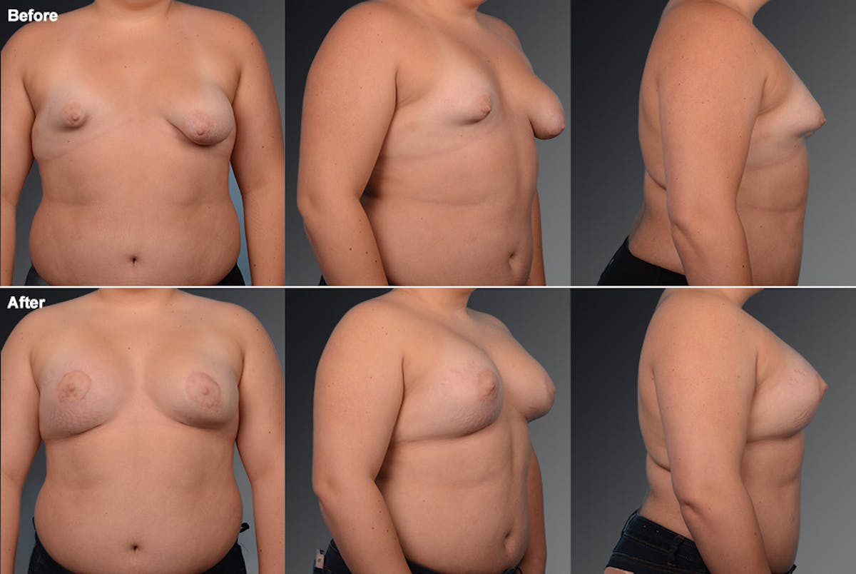 Breast Augmentation Before & After Gallery - Patient 104301329 - Image 1