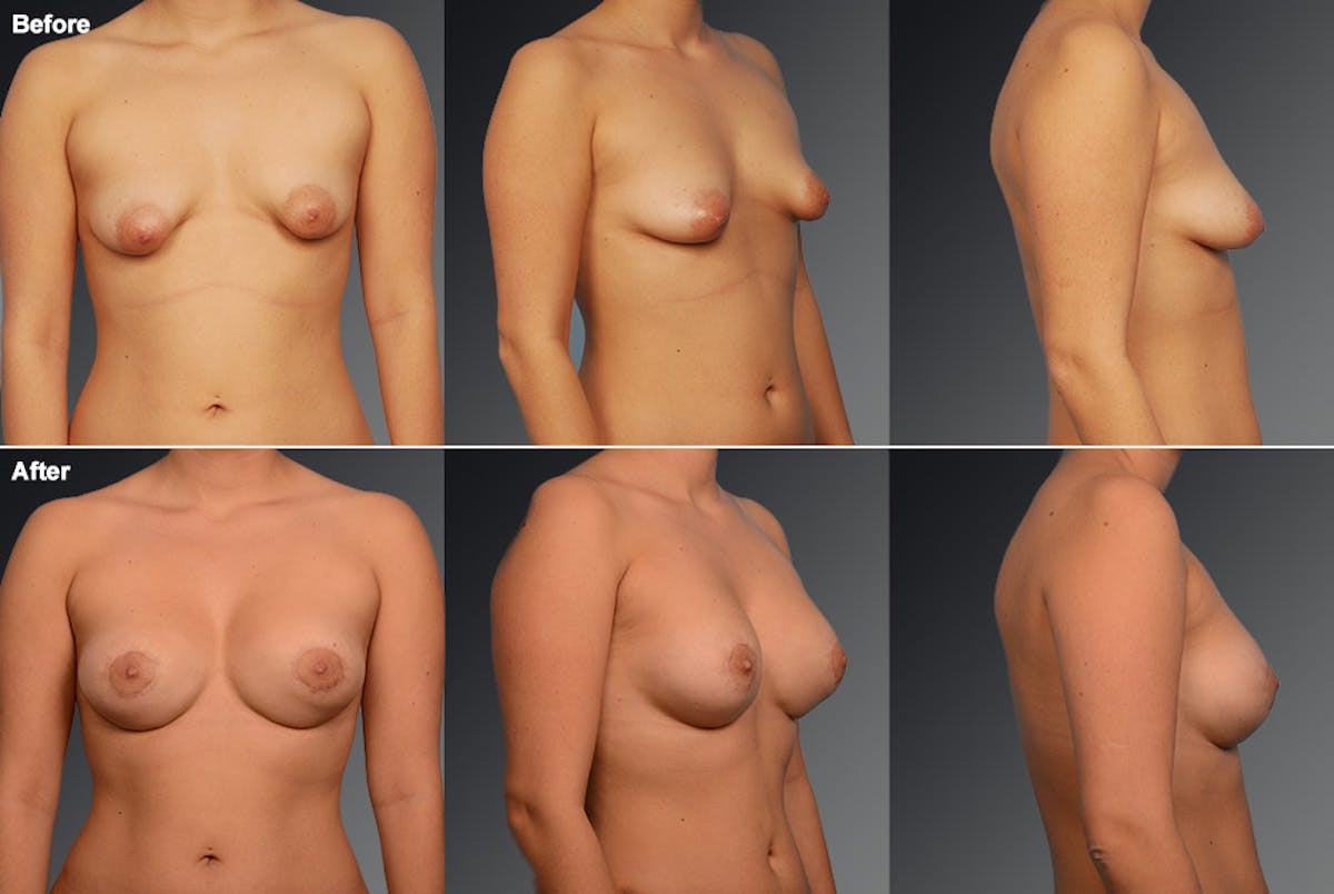 Breast Augmentation Before & After Gallery - Patient 104301346 - Image 1
