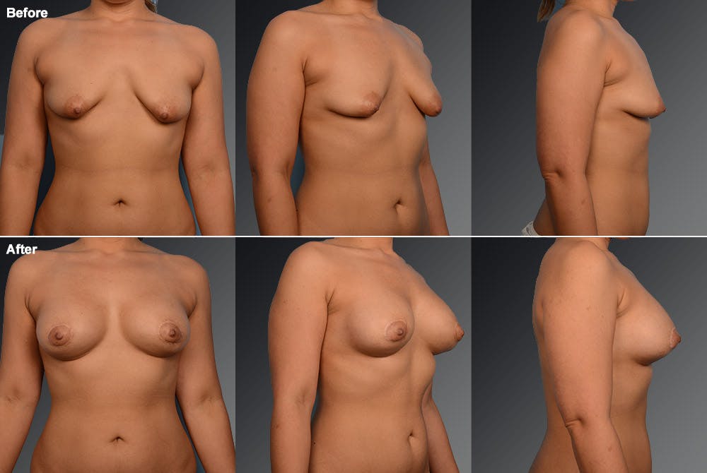 Breast Augmentation Before & After Gallery - Patient 104301349 - Image 1