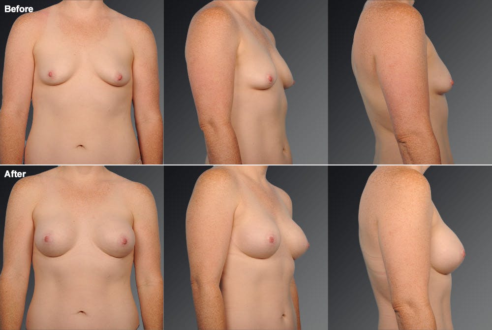 Breast Augmentation Before & After Gallery - Patient 104301350 - Image 1