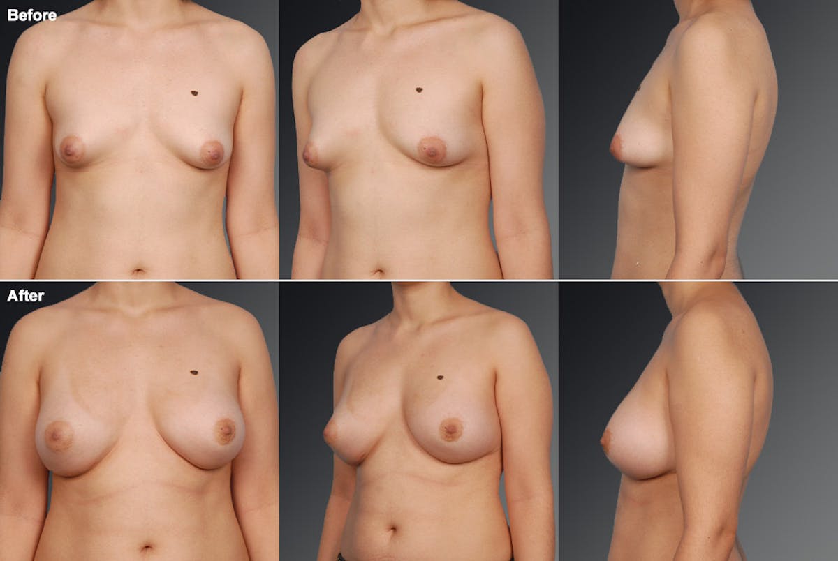 Breast Augmentation Before & After Gallery - Patient 104301353 - Image 1