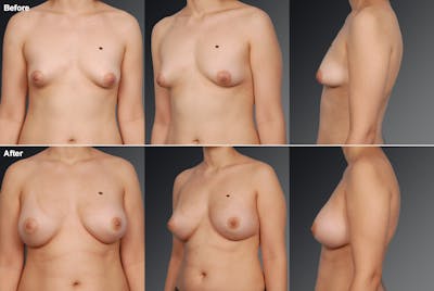 Breast Augmentation Before & After Gallery - Patient 104301353 - Image 1