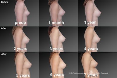 Breast Augmentation Before & After Gallery - Patient 104319611 - Image 1